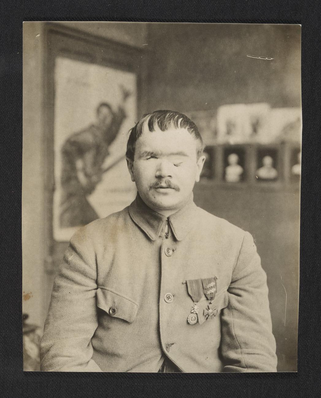 American Red Cross, A World War I soldier before facial reconstruction